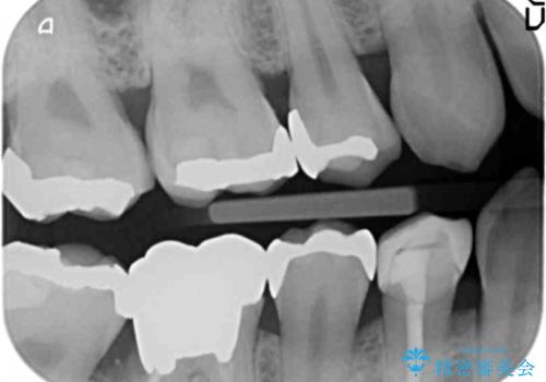 虫歯がひどく抜歯 奥歯をブリッジにの治療前