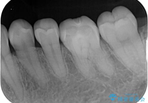 適合のよいセラミックで自分の歯となじむ自然な仕上がりにの治療後
