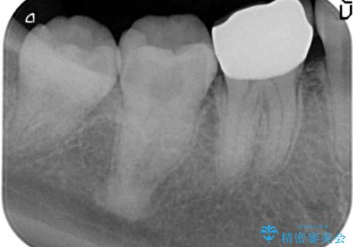 目立つ銀歯を白くしたいの治療後