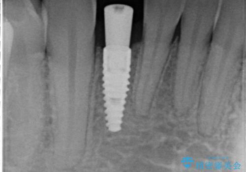 下の前歯のインプラント　生まれつき歯が少ないの治療中