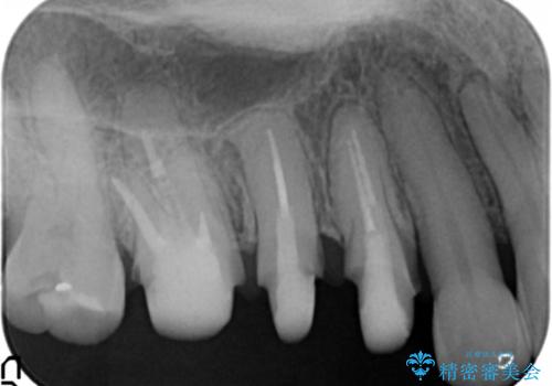 古くなったセラミッククラウンのやりかえの治療中