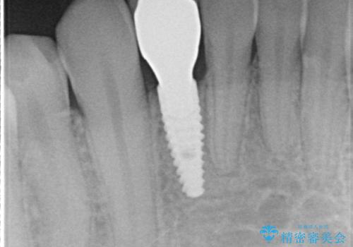 下の前歯のインプラント　生まれつき歯が少ないの治療後