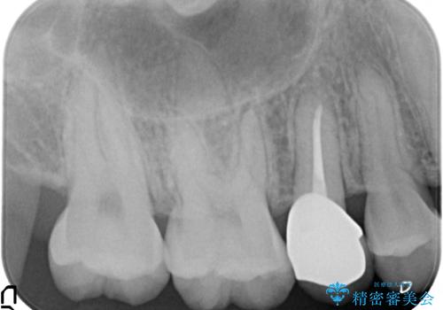 歯の高さがなく、しょっちゅう外れる 他院で治療途中だが病院を変えたいの治療後