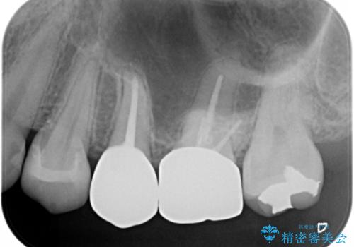 笑うとキラリと光る銀歯を何とかしたい:適合の良いセラミックで長持ちする歯にの治療後