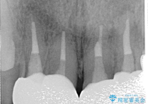 オールセラミッククラウン セラミックで前歯の見た目を改善の治療後