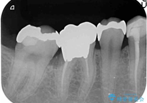 虫歯がひどく抜歯 奥歯をブリッジにの治療前