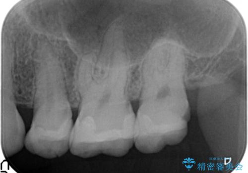 オールセラミッククラウン 欠けた歯の治療の治療前