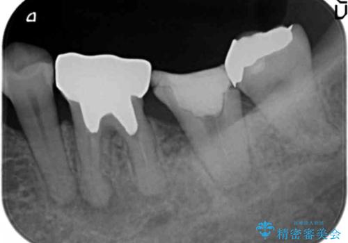 インプラントは嫌 親知らずの移植 50代女性の治療前