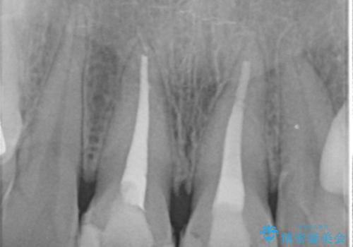 神経をとった前歯が変色してきたの治療前