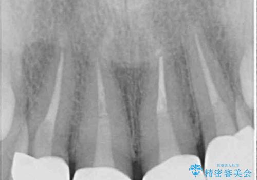 変色した歯をセラミックできれいにの治療後