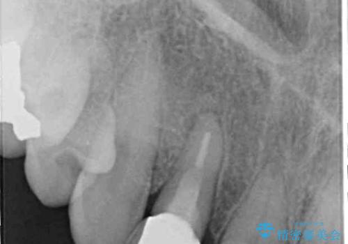 歯肉が腫れている前歯　外科処置を併用したオールセラミッククラウンの治療後