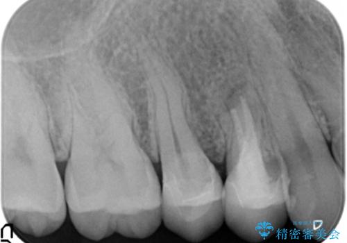 他院の根の治療で一向に治らない、さらに歯根を切ってもらったが良くならないの治療後