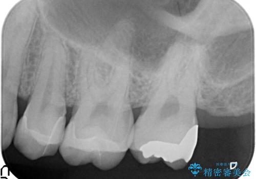 奥歯の詰め物のやりかえ セラミックインレー、ゴールドインレーの治療後