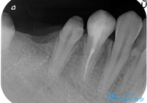 虫歯がひどく抜歯　奥歯をブリッジにの治療中