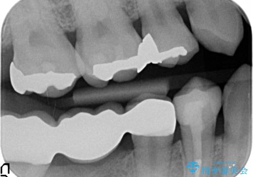 虫歯がひどく抜歯 奥歯をブリッジにの治療後