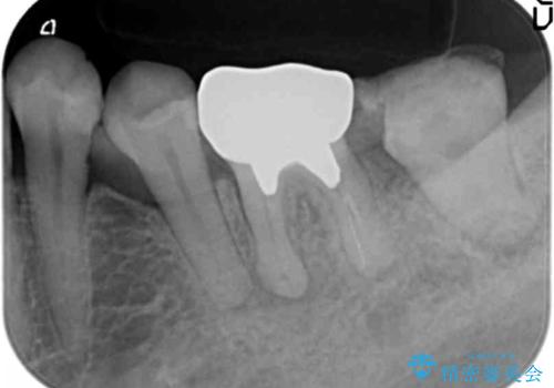 インプラントは嫌 親知らずの移植 50代女性の治療中