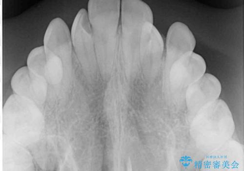 外科矯正は受けたくない 上顎骨拡大による妥協的な受け口治療の治療前