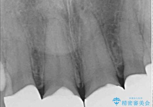 気になる前歯を美しく マウスピース矯正とセラミッククラウンの治療後