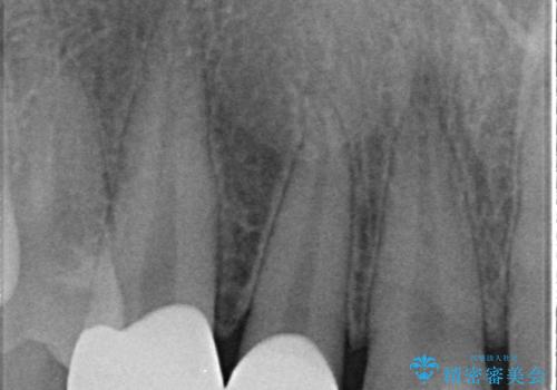 オールセラミッククラウン 色・形が気になる前歯の改善の治療後