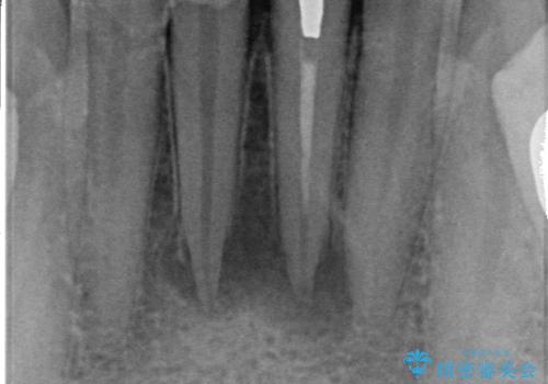 オールセラミッククラウン ブリッジによる欠損歯の補綴の治療前