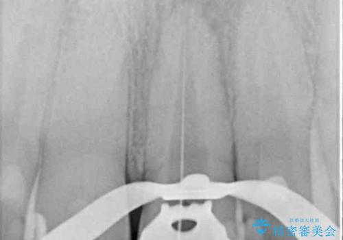 前歯の変色が気になる オールセラミッククラウンによる審美歯科治療の治療中