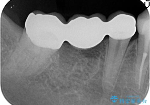 虫歯がひどく抜歯 奥歯をブリッジにの治療後
