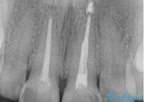 長さの気になる変色した前歯をオールセラミッククラウンにの治療前