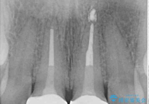 長さの気になる変色した前歯をオールセラミッククラウンにの治療後