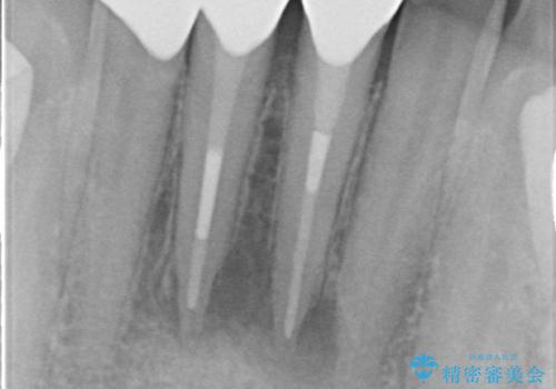 オールセラミッククラウン ブリッジによる欠損歯の補綴の治療後