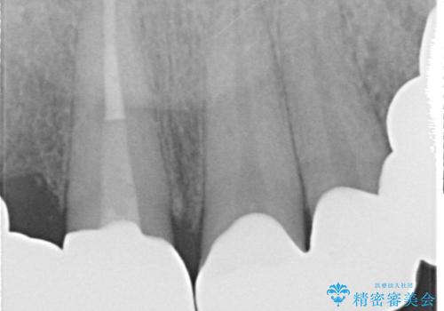 オールセラミッククラウン ブリッジによる欠損歯の補綴の治療後