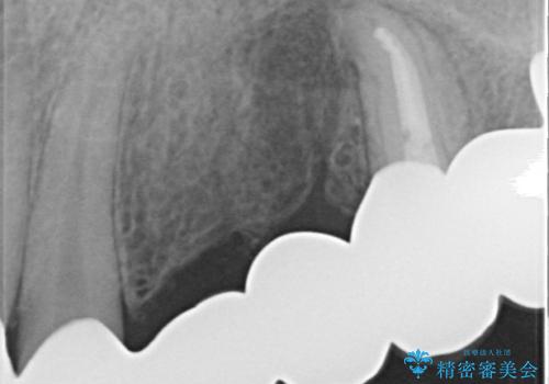 オールセラミッククラウン ブリッジによる欠損歯の補綴の治療後