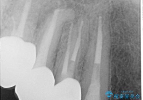 オールセラミッククラウン ブリッジによる欠損歯の補綴の治療後