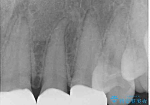 気になる前歯を美しく マウスピース矯正とセラミッククラウンの治療後