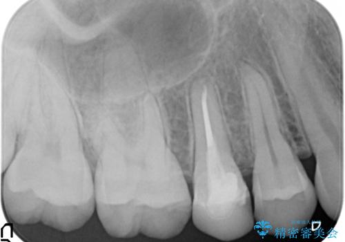 歯の高さがなく、しょっちゅう外れる 他院で治療途中だが病院を変えたいの治療前
