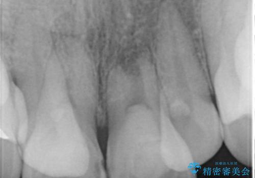 子供の頃にぶつけた前歯 根管治療から行うセラミック治療の治療中