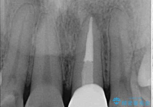 境目が見えている前歯のクラウンをオールセラミッククラウンにの治療後