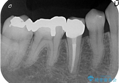 オールセラミッククラウン 違和感のある奥歯の治療の治療後
