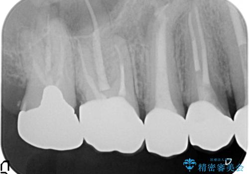 オールセラミッククラウン ブリッジによる欠損歯の補綴の治療後