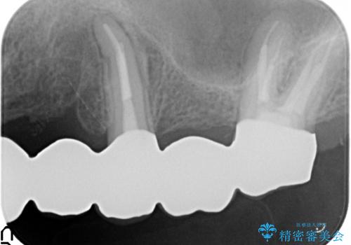 オールセラミッククラウン ブリッジによる欠損歯の補綴の治療後