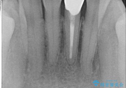 オールセラミッククラウン 変色した前歯をセラミックで白くの治療後