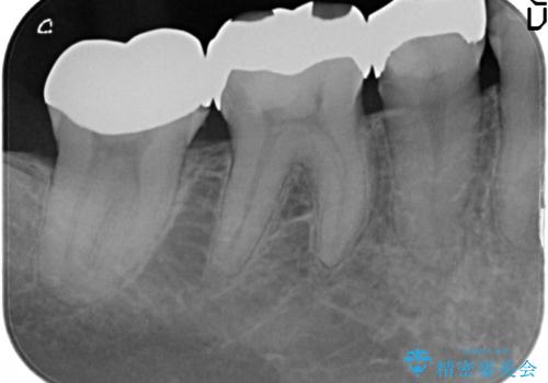 オールセラミッククラウン 神経が死んでいる歯の治療の治療前