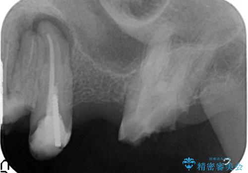 オールセラミッククラウン ブリッジによる欠損歯の補綴の治療前