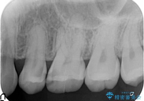 セラミックインレーとゴールドインレーの治療前