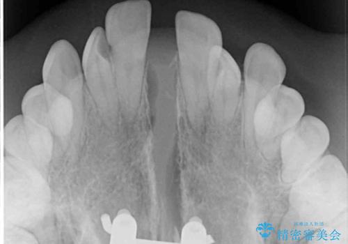 外科矯正は受けたくない 上顎骨拡大による妥協的な受け口治療の治療中