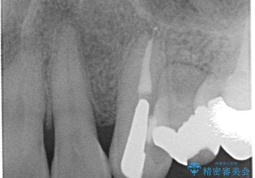オールセラミッククラウン 再根管治療後の補綴の治療前