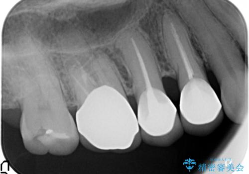 古くなったセラミッククラウンのやりかえの治療前
