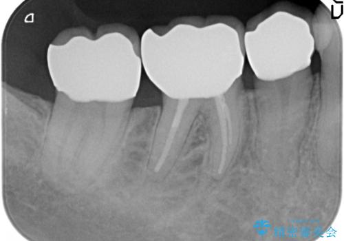 オールセラミッククラウン 神経が死んでいる歯の治療の治療後