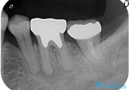 インプラントは嫌 親知らずの移植 50代女性の治療後
