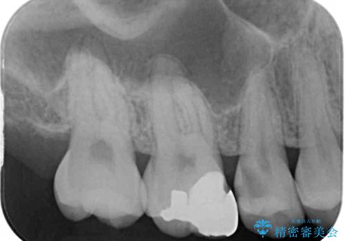 虫歯がしみる　セラミックインレーによる修復治療の治療前