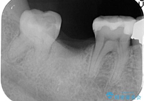右下の奥歯を抜歯　インプラント治療による咬合回復の治療前